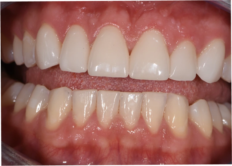 Zähne nach der Behandlung mit Veneers für ein ästhetisches Lächeln.
