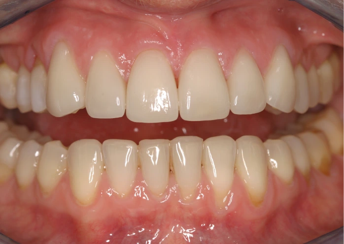 Perfekte Zähne und gesundes Zahnfleisch nach Veneers-Behandlung.
