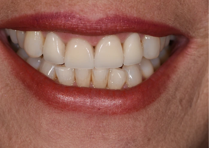 Lächeln nach einer Veneers-Behandlung, das gleichmäßige und ästhetisch ansprechende Zähne zeigt.