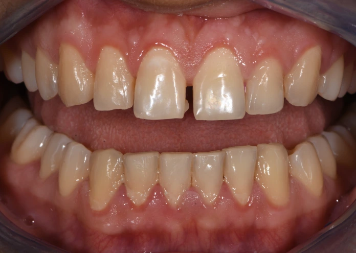 Zähne vor der Behandlung mit Veneers, die vorhandene Lücken und Unregelmäßigkeiten zeigen.