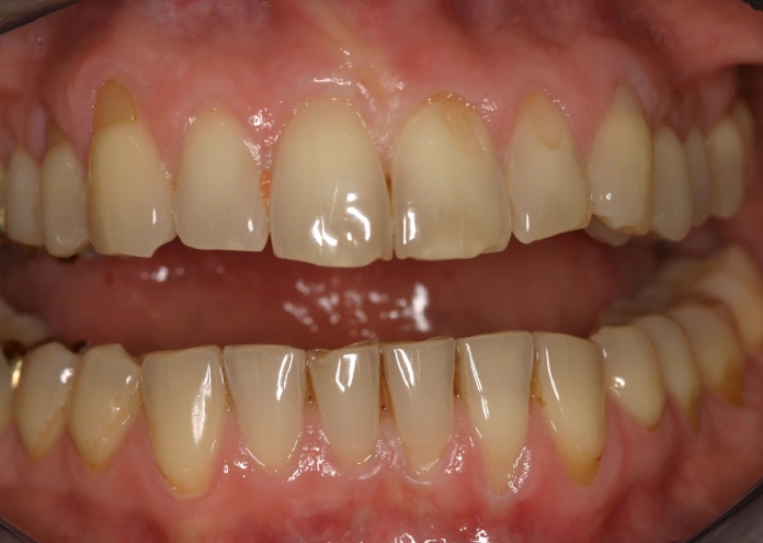 Zähne vor der Behandlung mit Veneers zur Verbesserung des Lächelns.