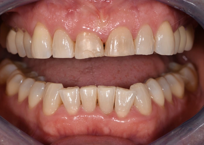 Nahaufnahme der Zähne vor einer Veneers-Behandlung, die beschädigte und ungleichmäßige Vorderzähne zeigt.